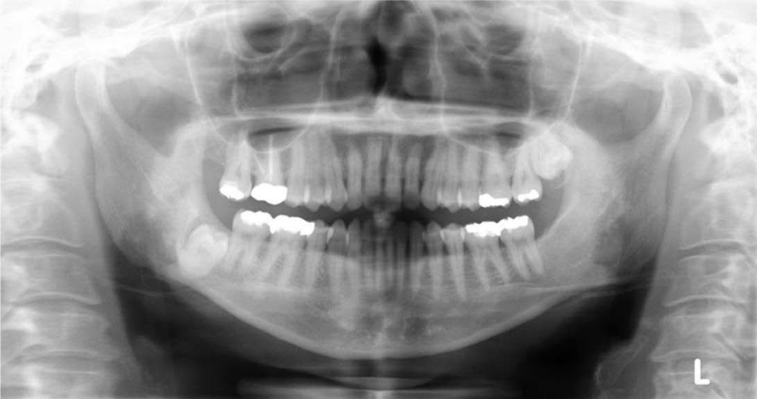 A Deeply Impacted Mandibular Third Molar With Its Root Protruding From